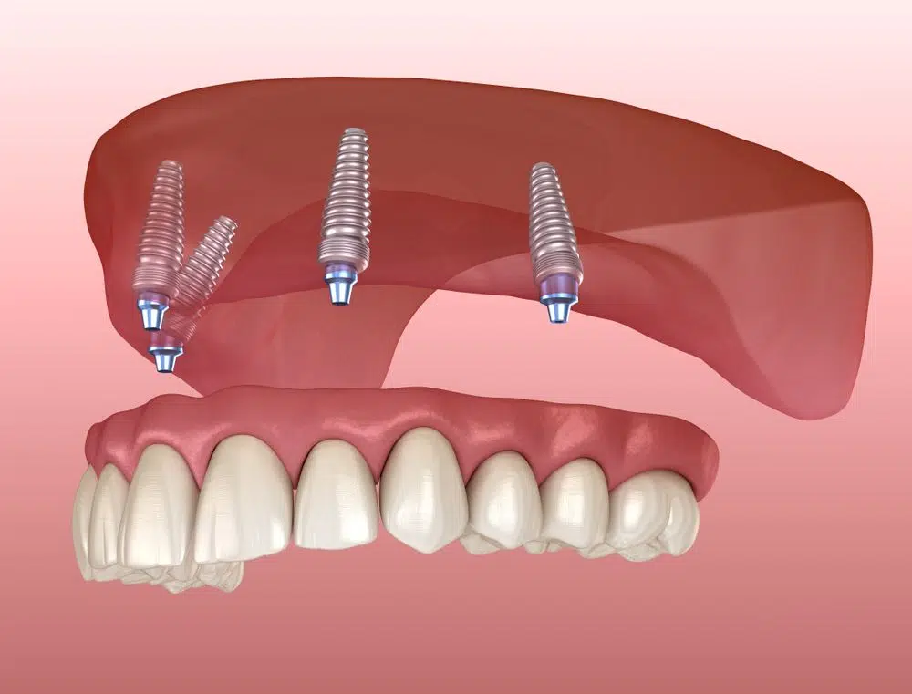 All-On-4 Dental Implants Solution