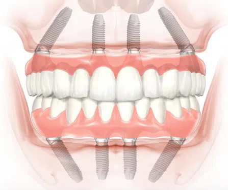 All-On-4 Dental Implants