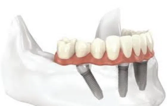 All-On-4 Smile Transformation