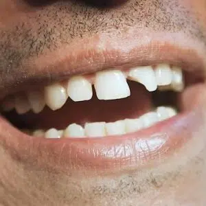 Smile restoration cracked tooth