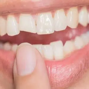 Cracked tooth treatment Newport