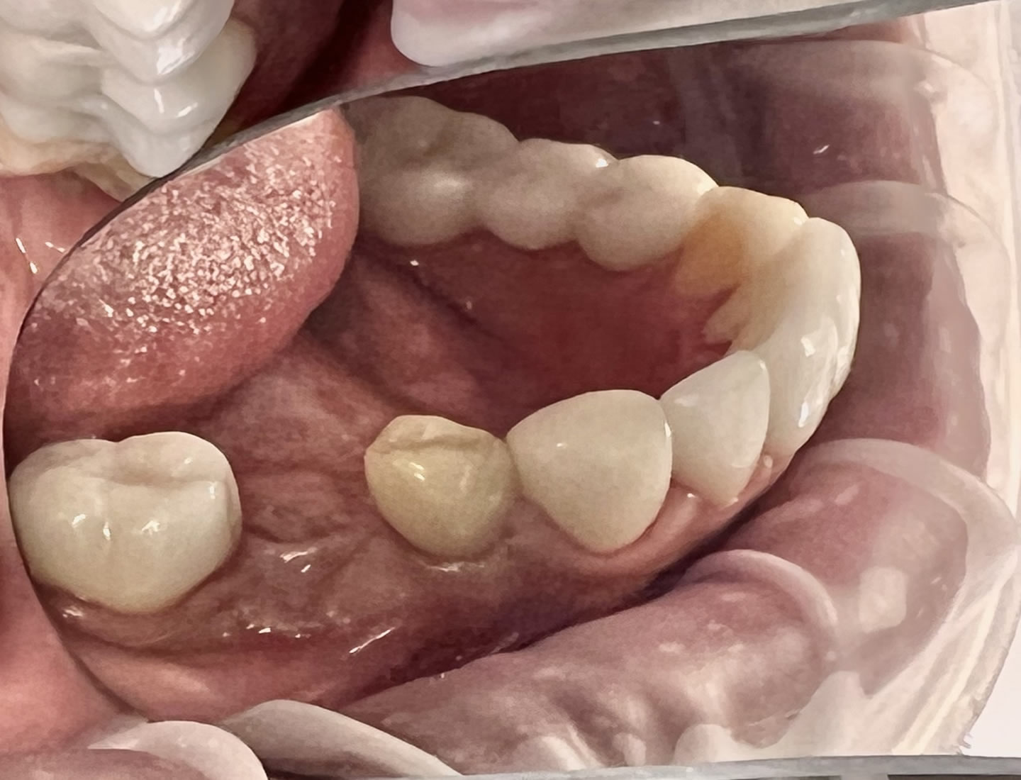 Dental Bridges