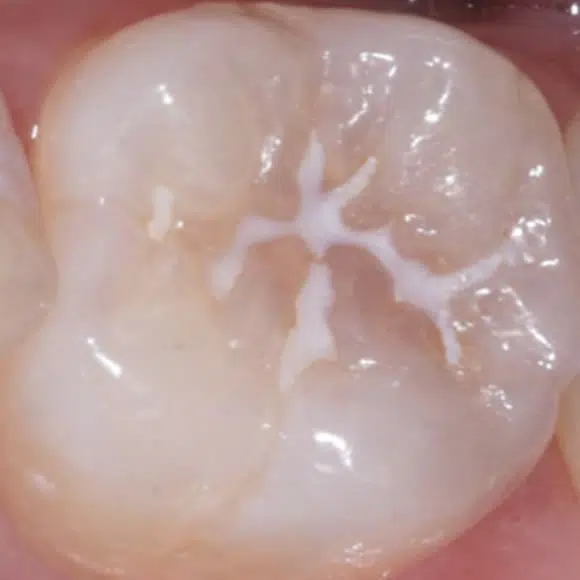 Dental Sealant Newport Beach Newport Beach Smile Studio Newport Beach