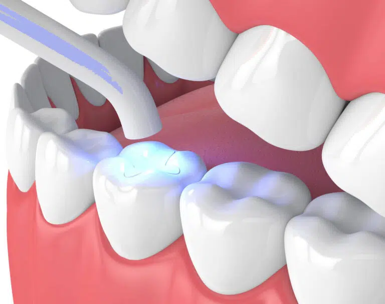 Dental Sealants Newport Beach Ca