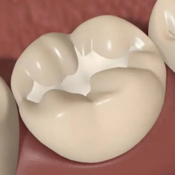 Dental sealant treatment Newport Beach