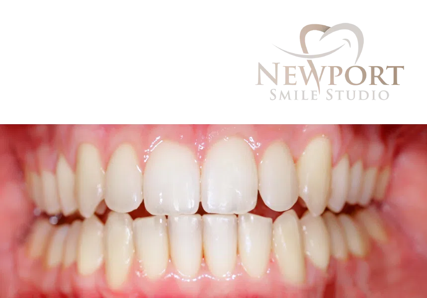 Newport Smile Studio Invisalign results