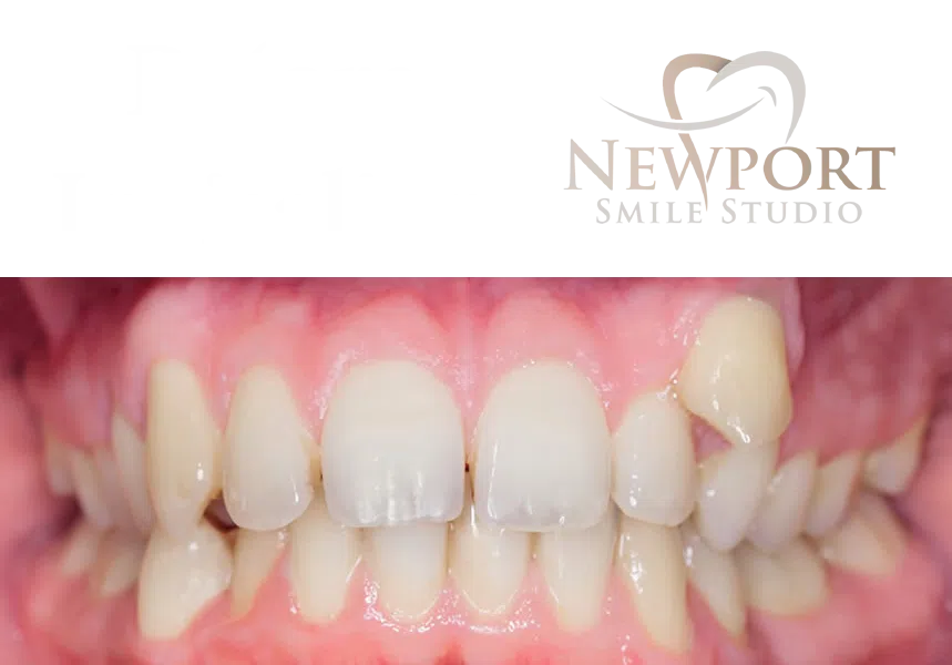 Irvine Invisalign smile transformation