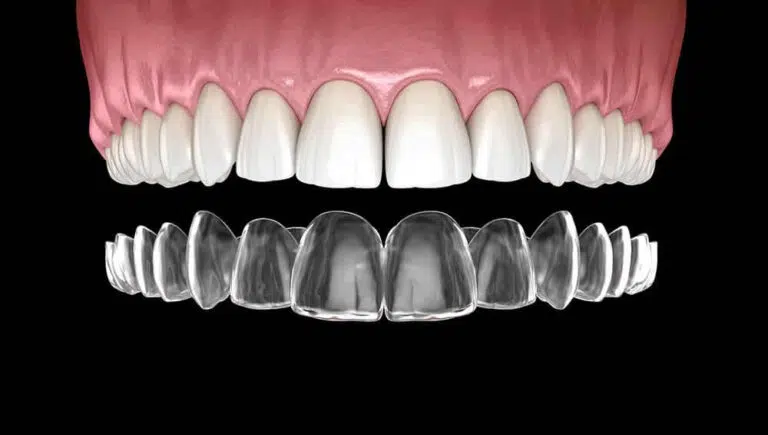 Invisalign treatment Newport Beach