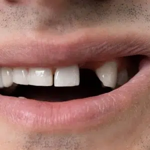 Knocked-out teeth emergency care