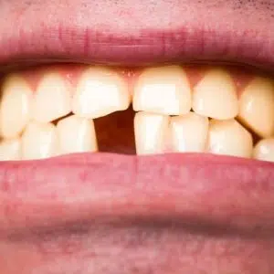Knocked out tooth treatment