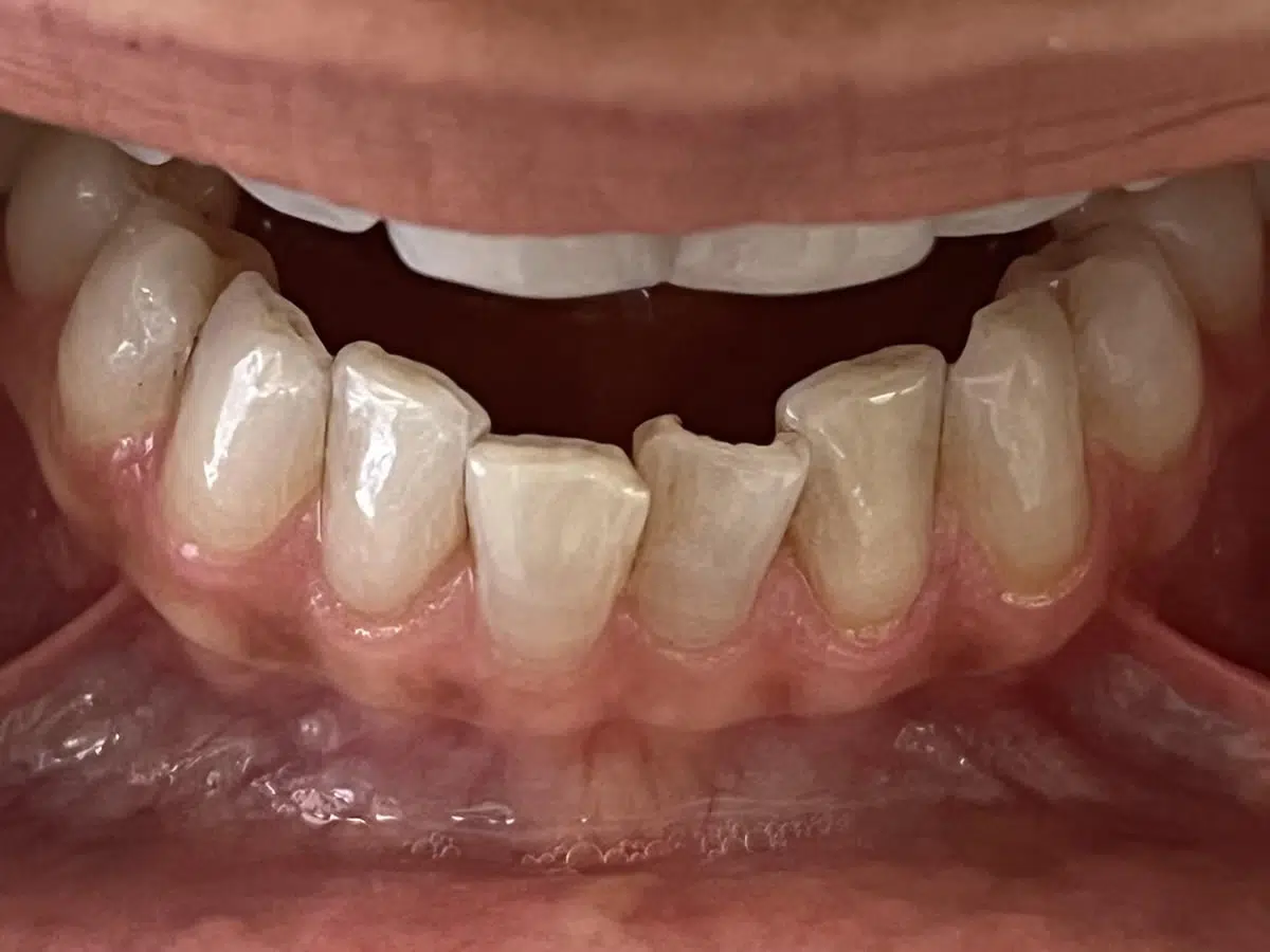 Lower Crown Dentist Irvine CA