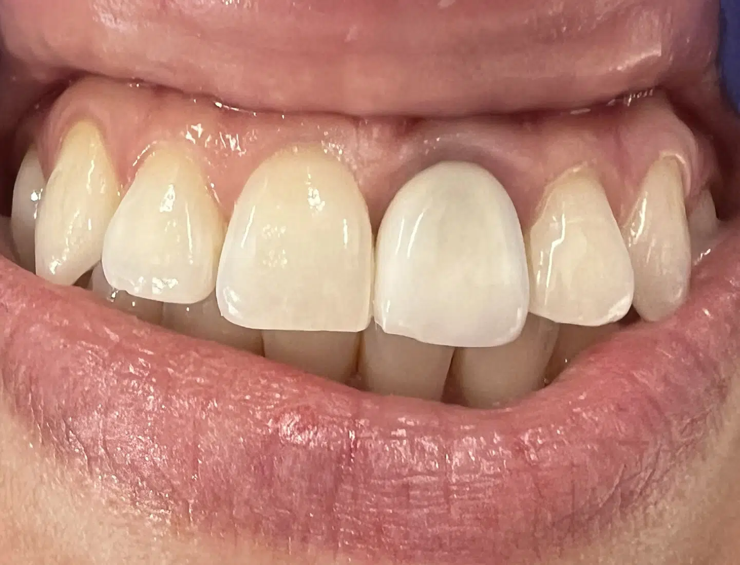 Cosmetic Crowns Newport Beach Newport Smile Studio Before