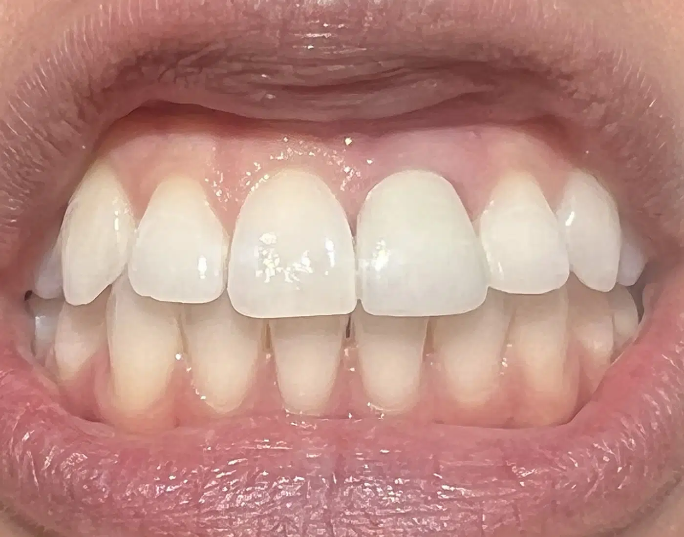 Cosmetic Crowns Newport Beach Newport Smile Studio