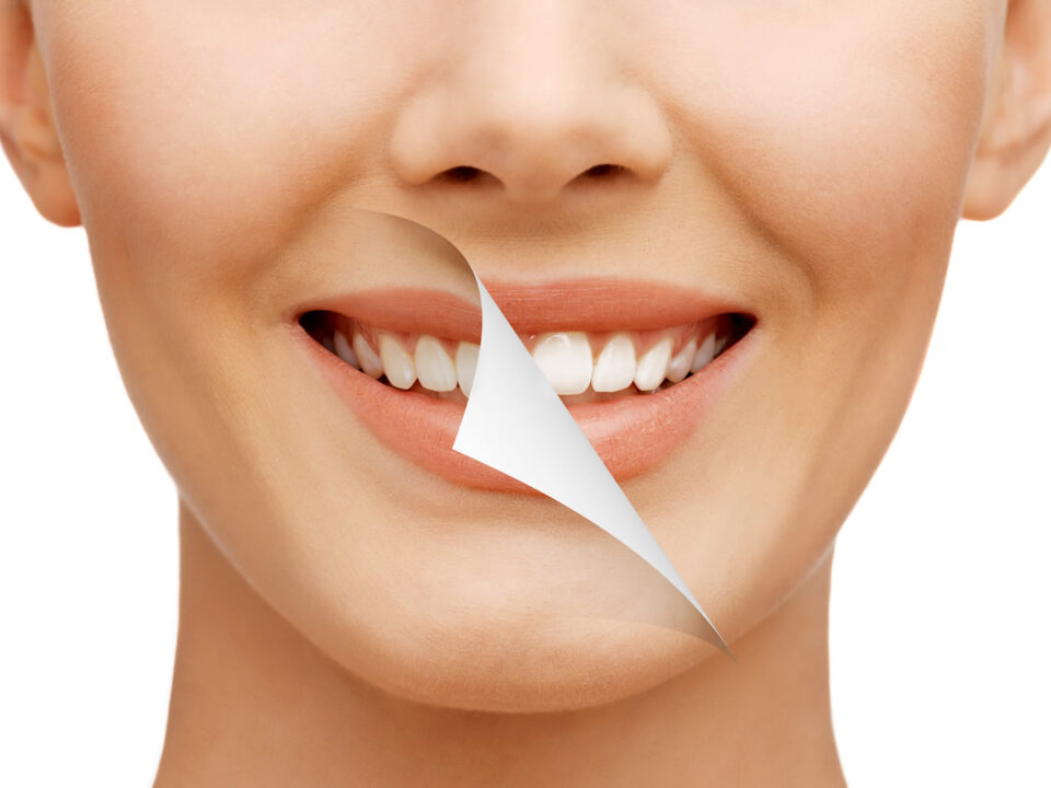 Teeth Whitening Newport Beach Zoom Teeth Whitening