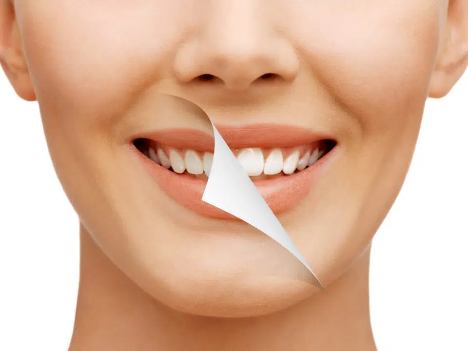 Teeth Whitening Newport Beach Zoom Teeth Whitening