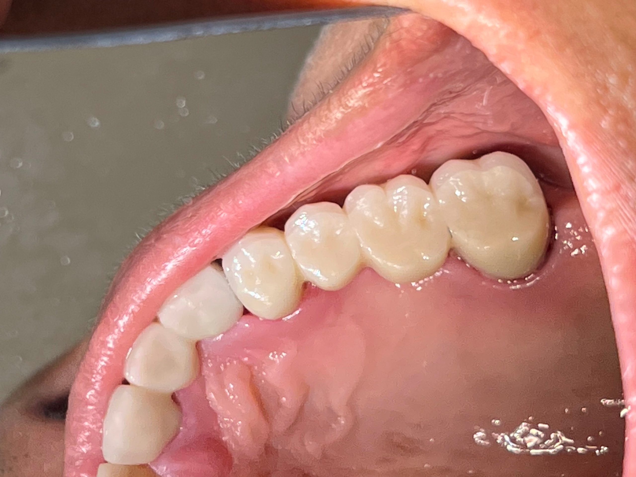 Dental Bridges