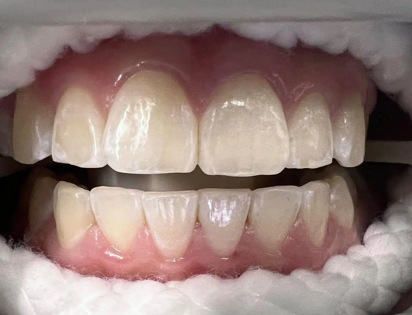 Zoom whitening procedure Newport Beach