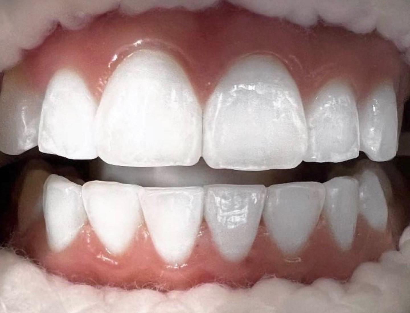 Zoom Teeth Whitening Dentist Newport Beach CA