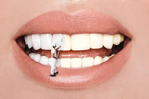 Professional teeth whitening treatment