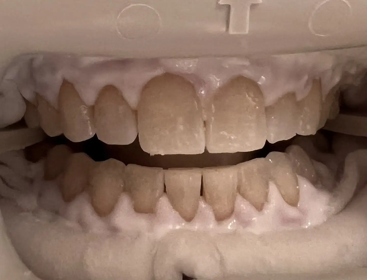 Zoom-Teeth-Whitening-Newport-Beach-Ca-Newport-Smile-Studio-1