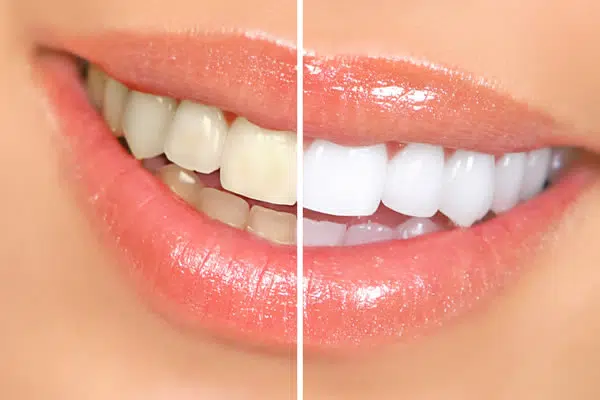 Zoom Teeth Whitening Newport