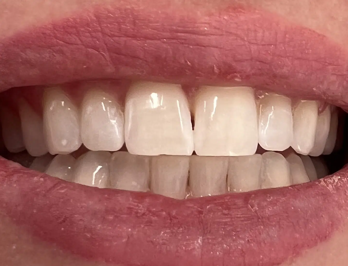 Teeth Whitening Newport Beach CA