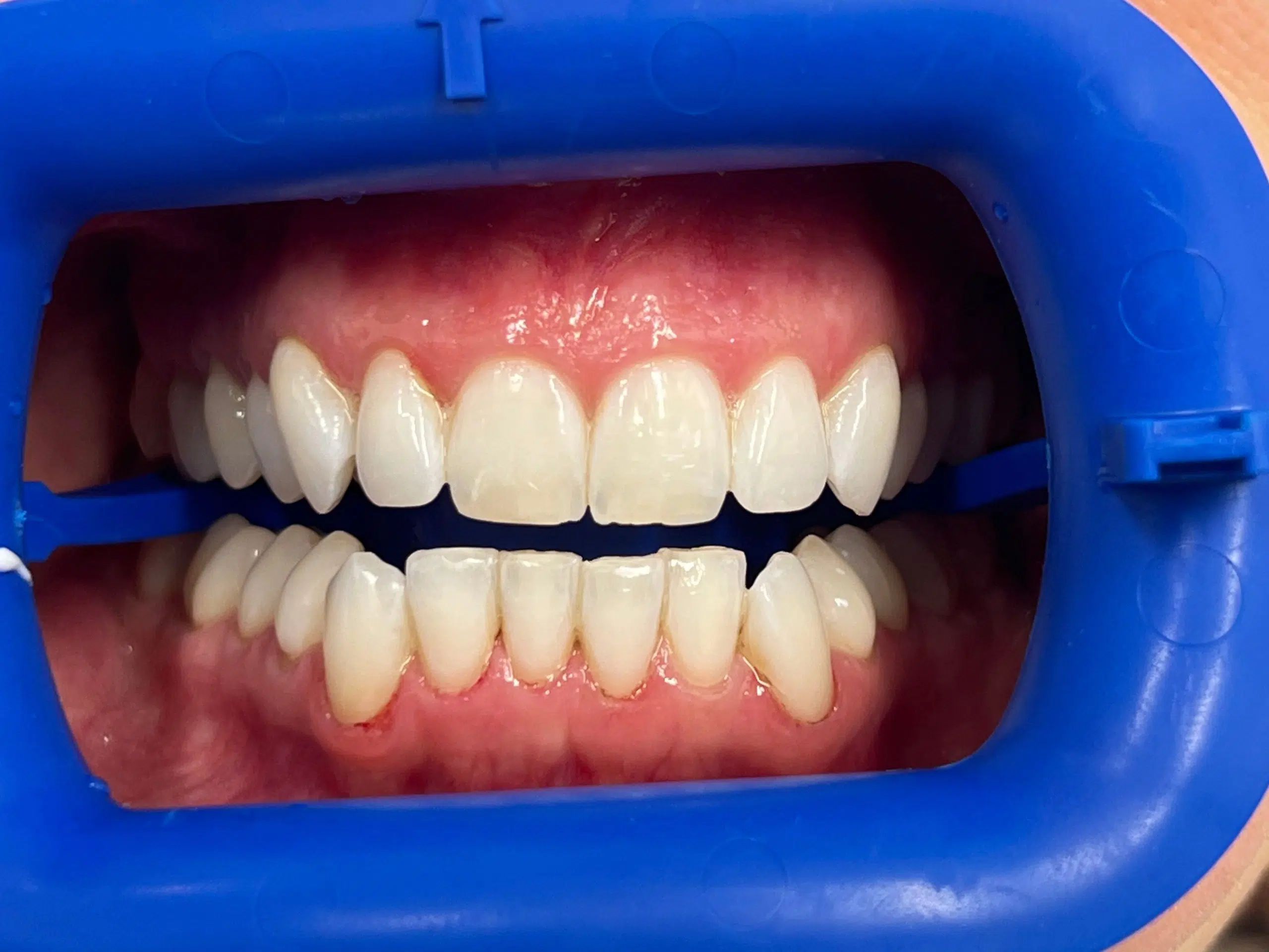 Before wedding teeth whitening