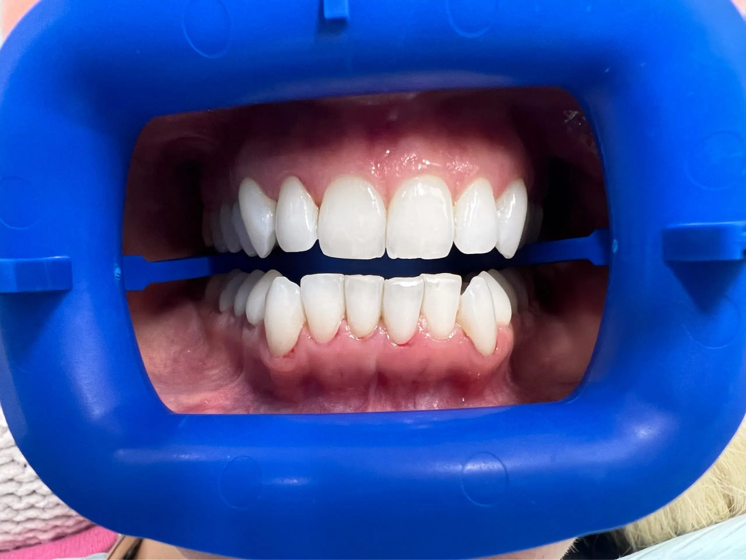 Zoom whitening treatment before wedding