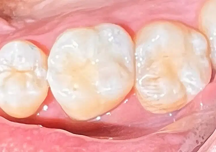Cavity Filling Replacement Newport Beach