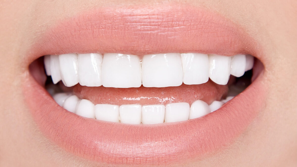 Veneers from The Gentle Dentist of Newport Beach