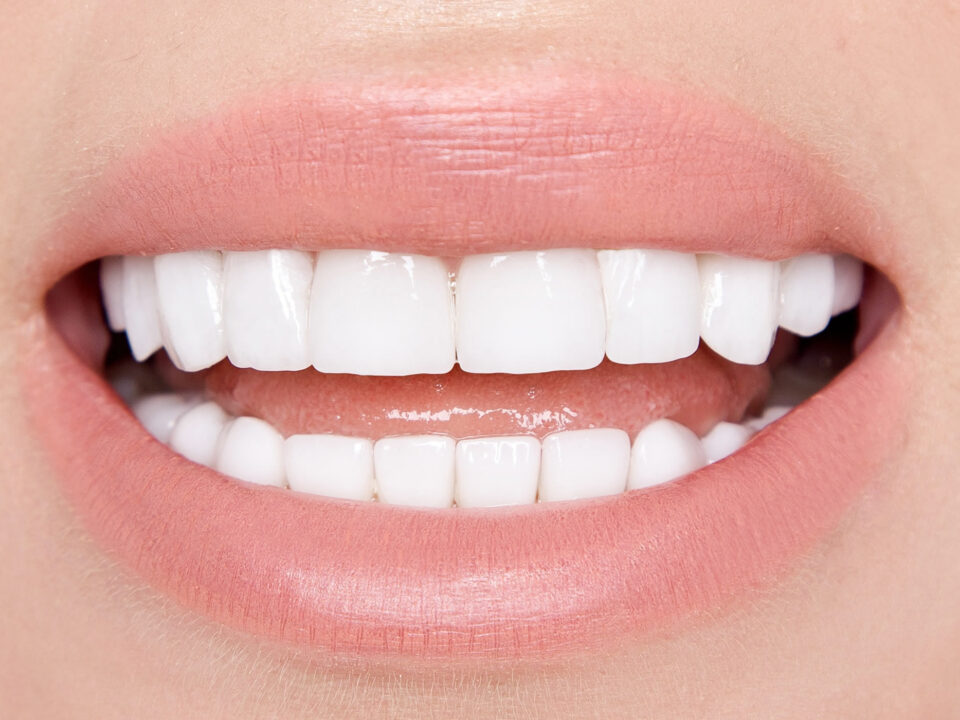 Veneers from The Gentle Dentist of Newport Beach