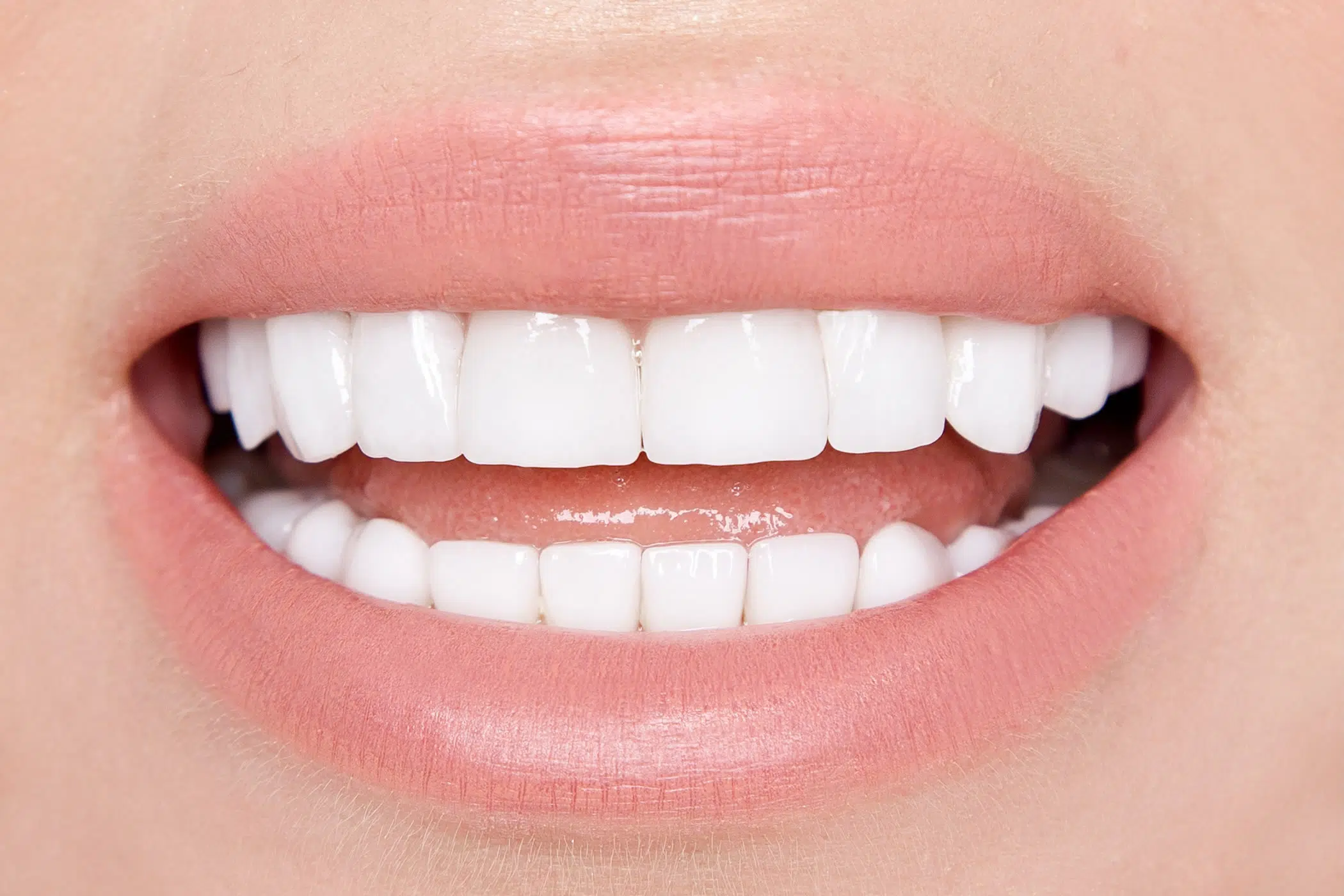 Veneers from The Gentle Dentist of Newport Beach