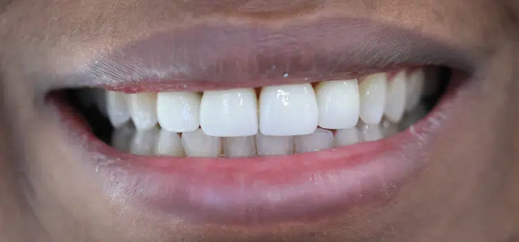 Dental Crowns After Newport Beach Ca Newport Smile Studio