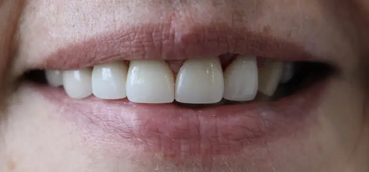 Dental Crowns After Newport Beach Ca