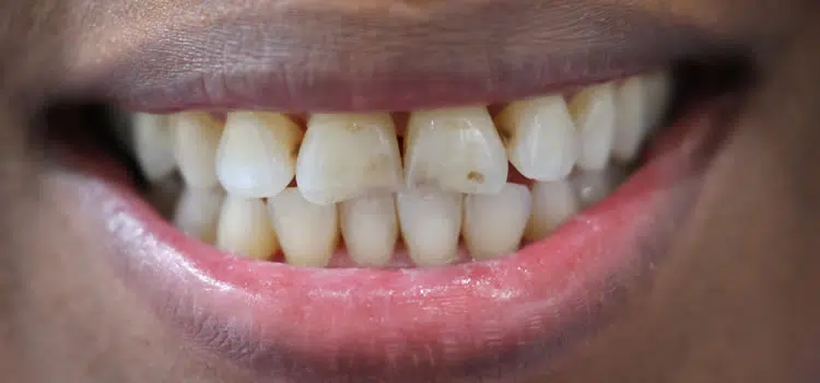 Dental Crowns Before Newport Beach Ca Newport Smile Studio