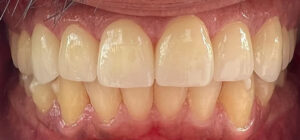 Front Tooth Crown Dentistry Newport Beach CA Dr Etemad DMD