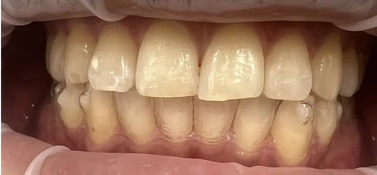 Crowns Dentist in Newport Beach