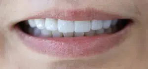 Veneers in Newport Beach Ca