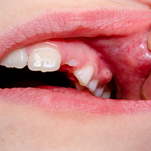 Tooth-Abcess-Newport-Smile-Image2
