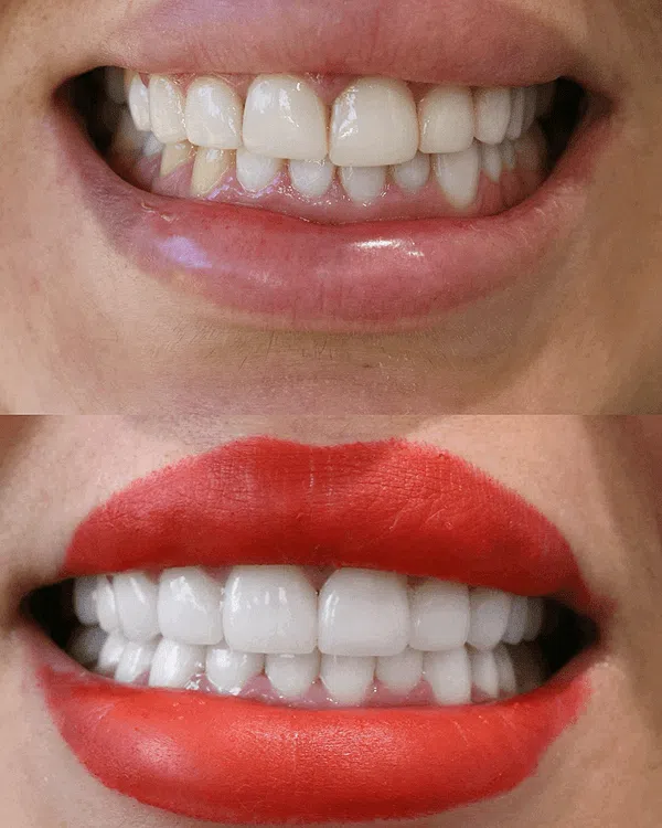 Cosmetic dentistry veneers makeover Newport Beach