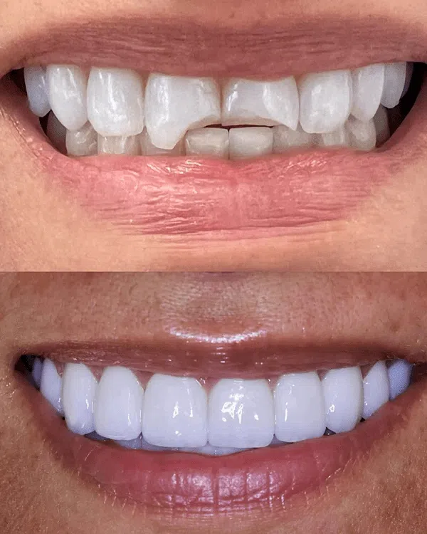 Close-up of smile makeover with veneers in Newport Beach
