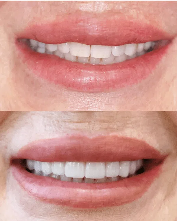 Before and after veneers transformation in Newport Beach