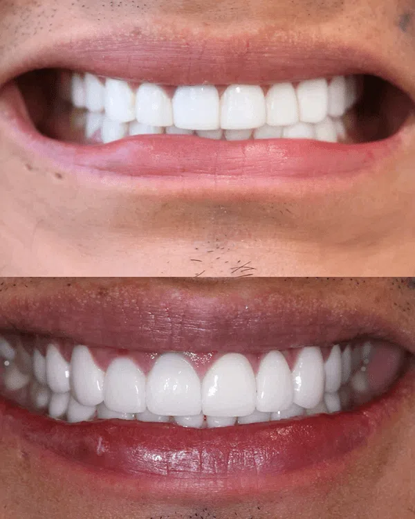 Front teeth veneers result – Newport Beach before & after