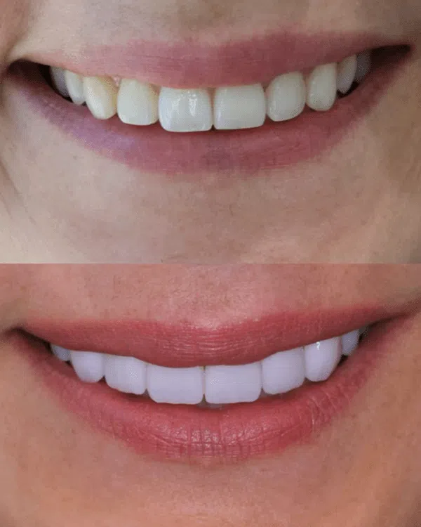 Newport Beach patient smile enhancement with veneers