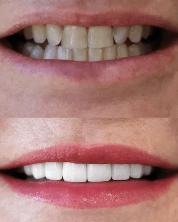Before and after dental veneer procedure in Newport Beach