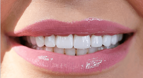Natural-looking veneers result in Newport Beach