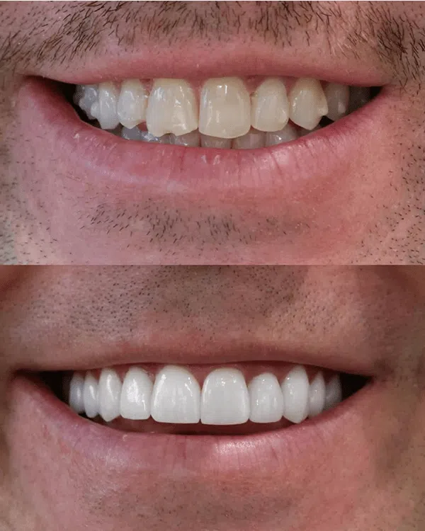 Smile improvement with veneers in Newport Beach – before and after