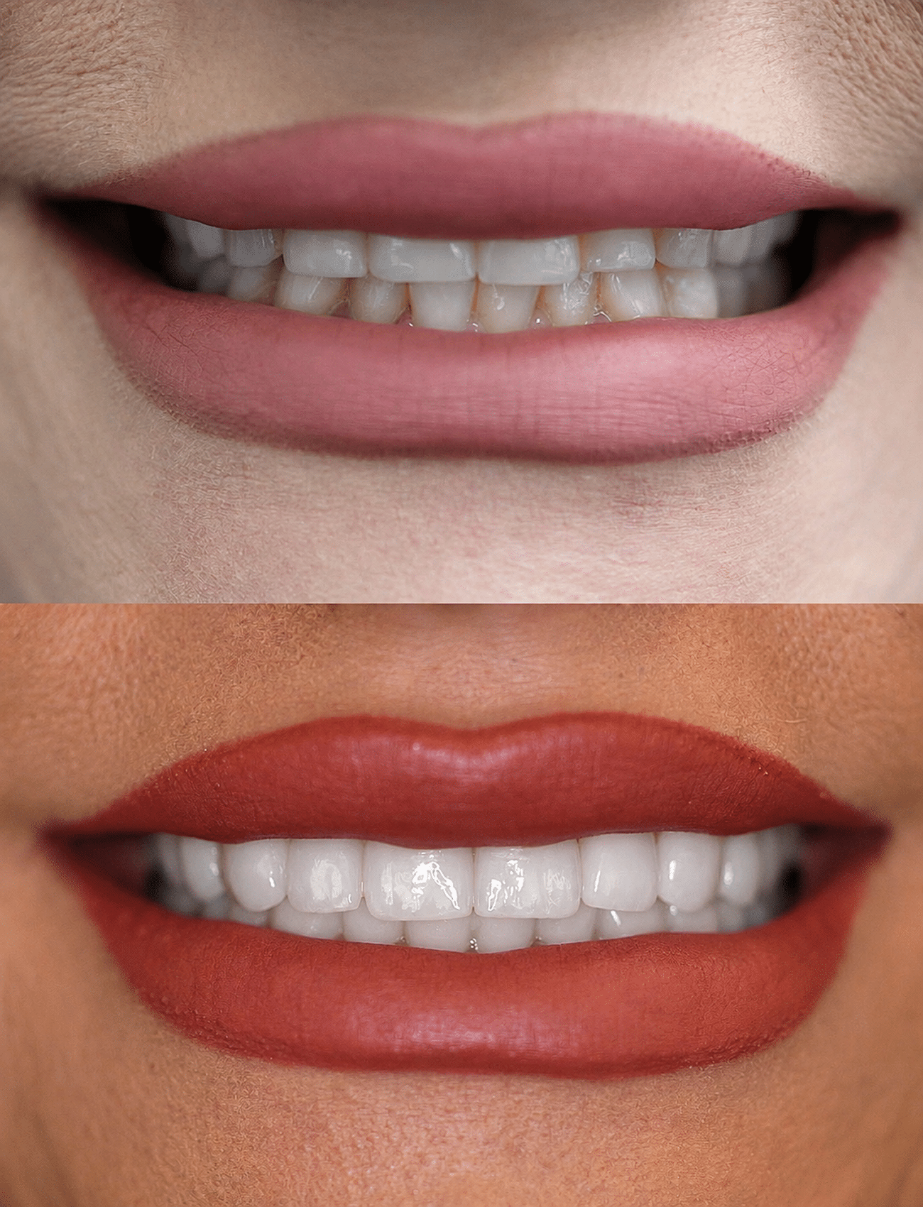 Veneers Dentist Newport Beach 24.fw