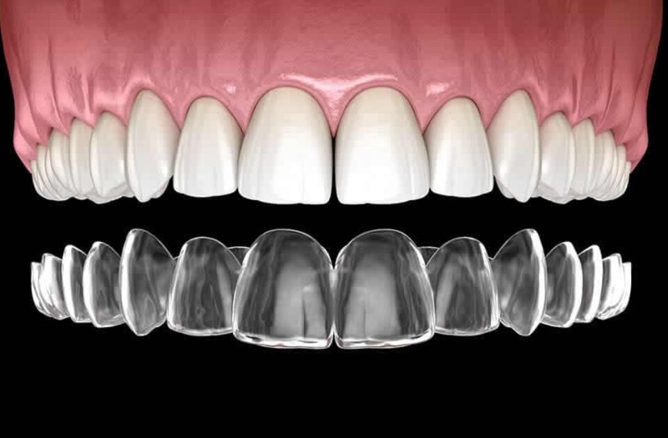 average cost of invisalign — featured image