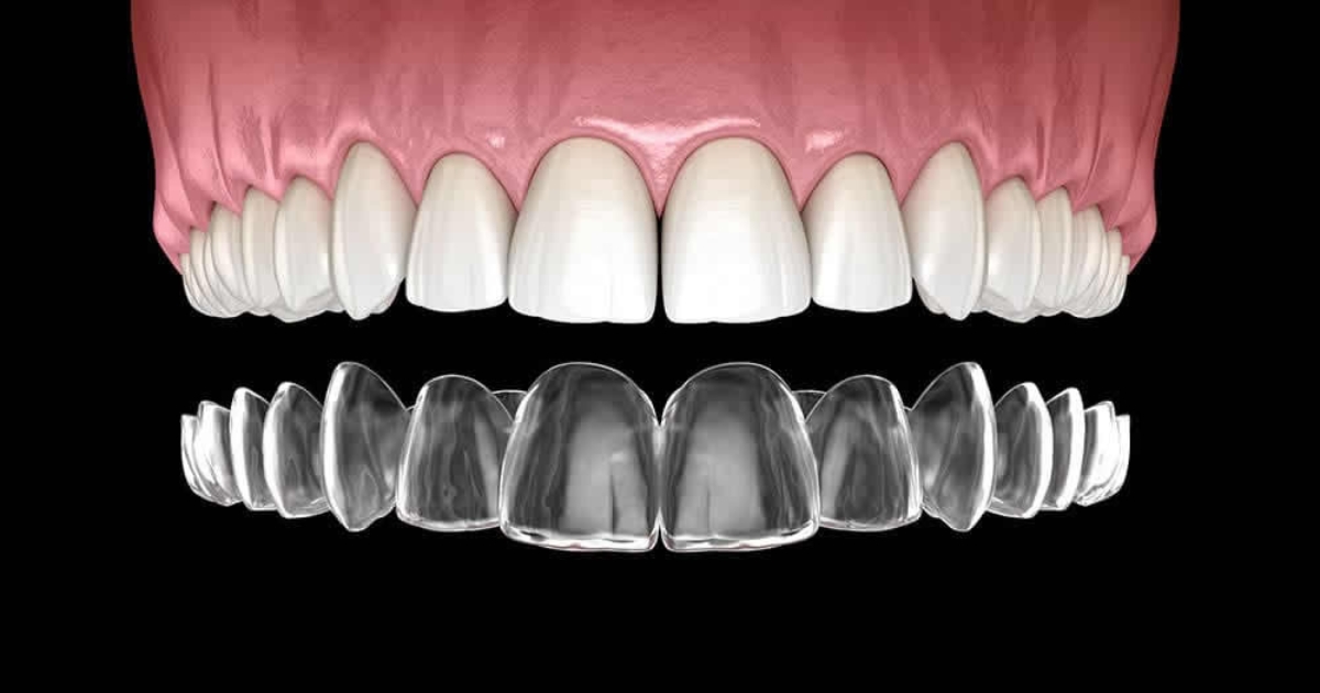 average cost of invisalign — featured image